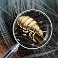 Avaderma Skin & Hair Clinic - Pediculosis (Lice)
